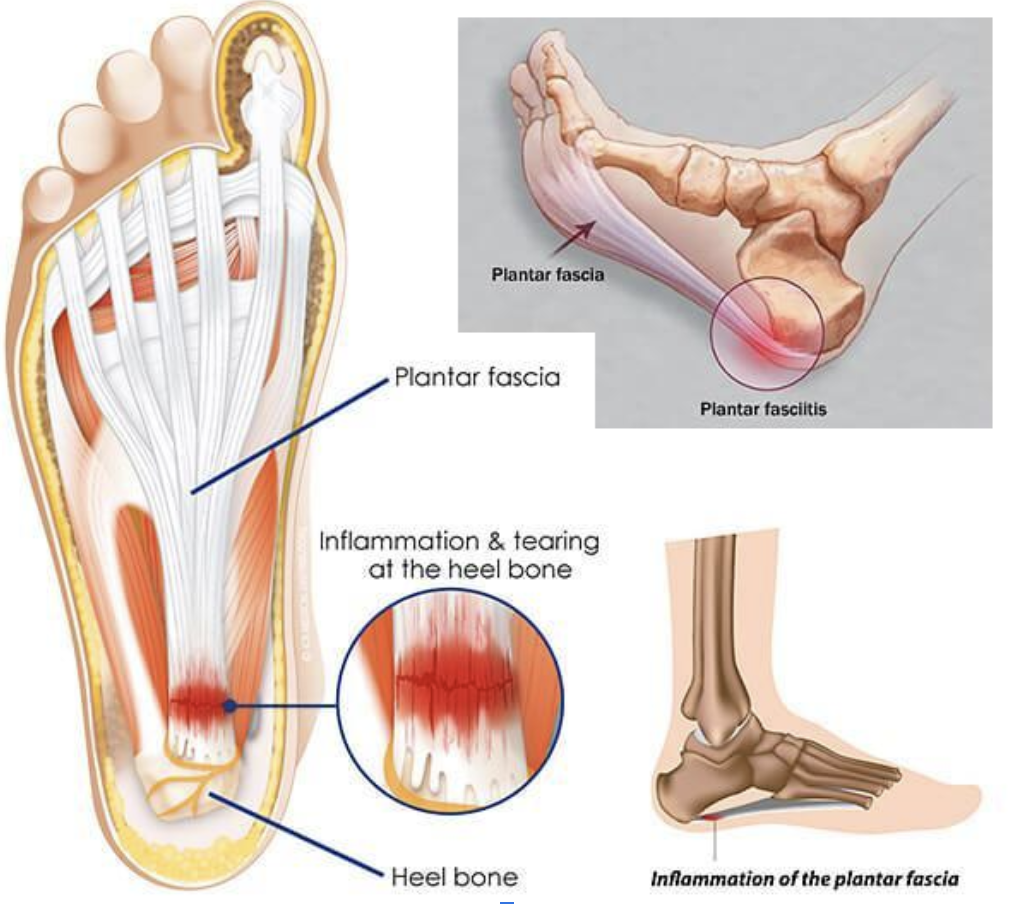 Plantar Fasciitis Relief: Effective Management Tips from ADAPT Recharge